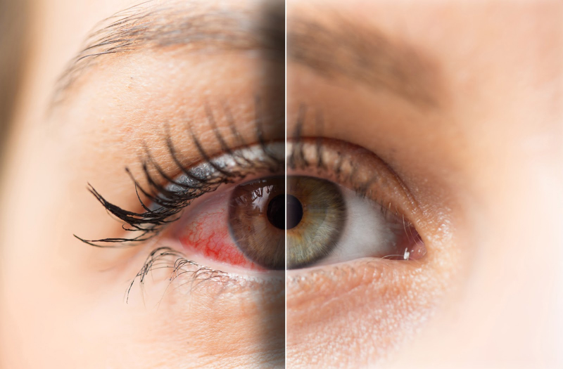 Why Does Weed Make Your Eyes Red and How to Get Rid of It?